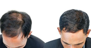 Hair Growth Restoration with PRP and Red Light