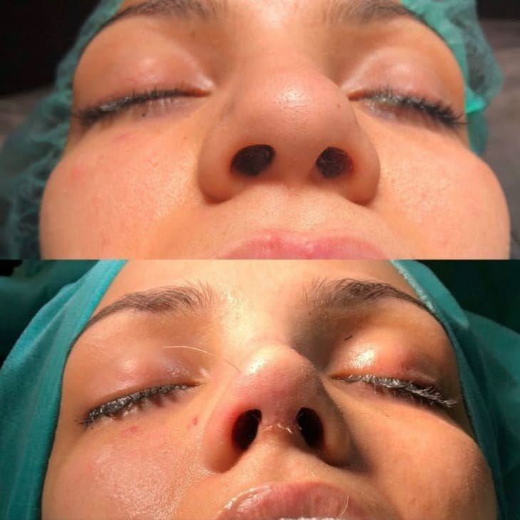 rhinoplasty (1)