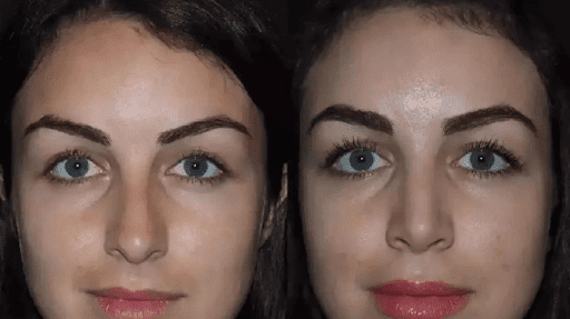 rhinoplasty in Dubai.