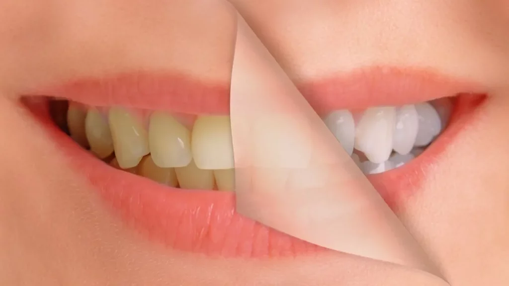 Teeth Whitening Fayetteville NC