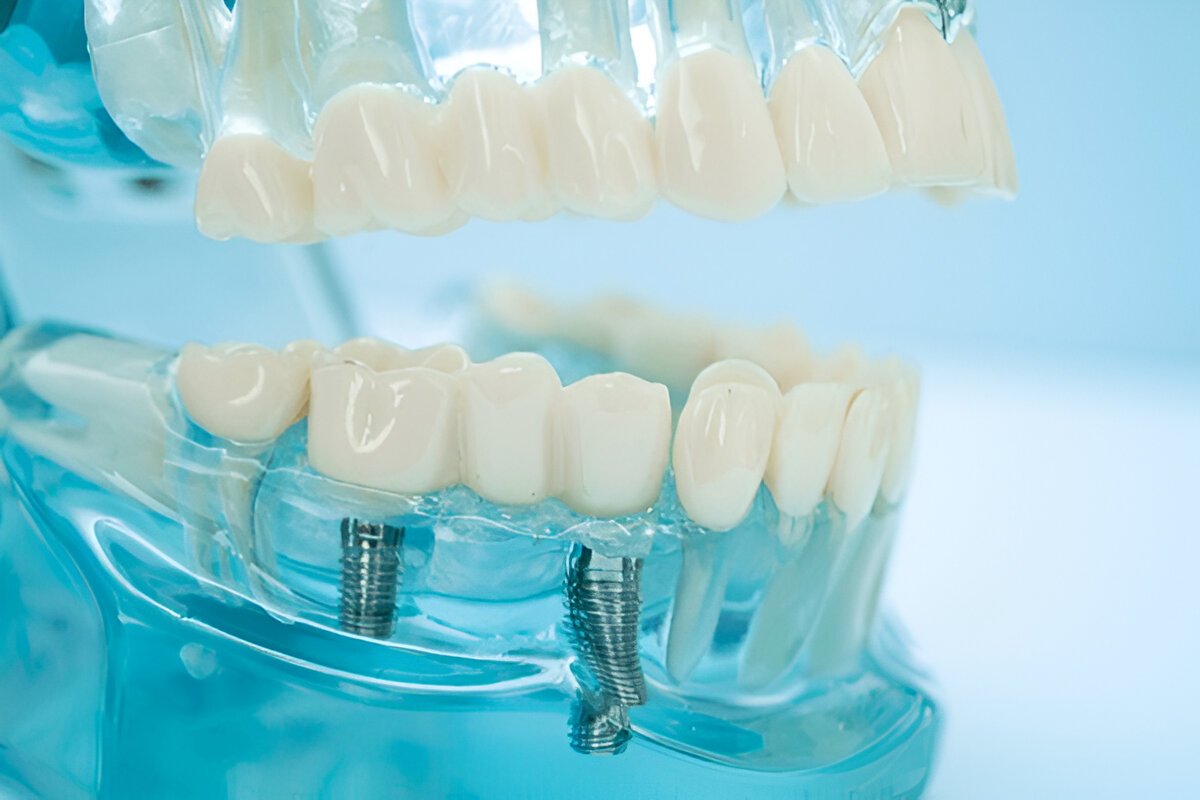 Elevate Your Smile with Premier Dental Implants in Burns Lake
