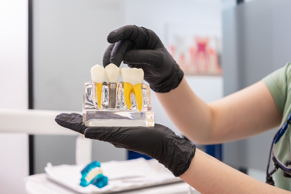 Discover the Life‑Changing Benefits of Dental Implants